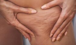 Remedios caseros para la celulitis