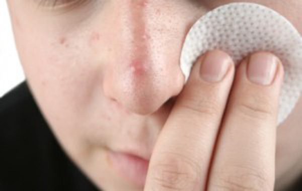 remedios caseros para tratar el acné 