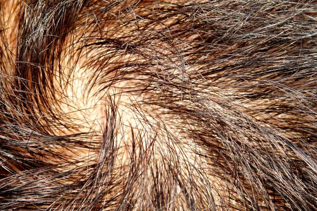lucha contra la calvicie con remedios caseros para el crecimiento del cabello