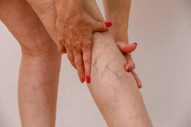 Várices en las piernas: Alivia el dolor y la inflamación de forma natural